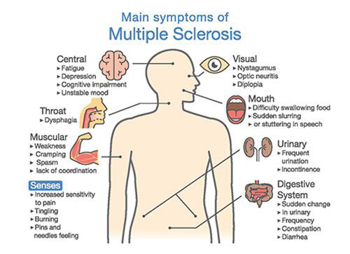 multiple_sclerosis_symptoms_500W_AdobeStock_181735729-[Converted]-copy-compressor